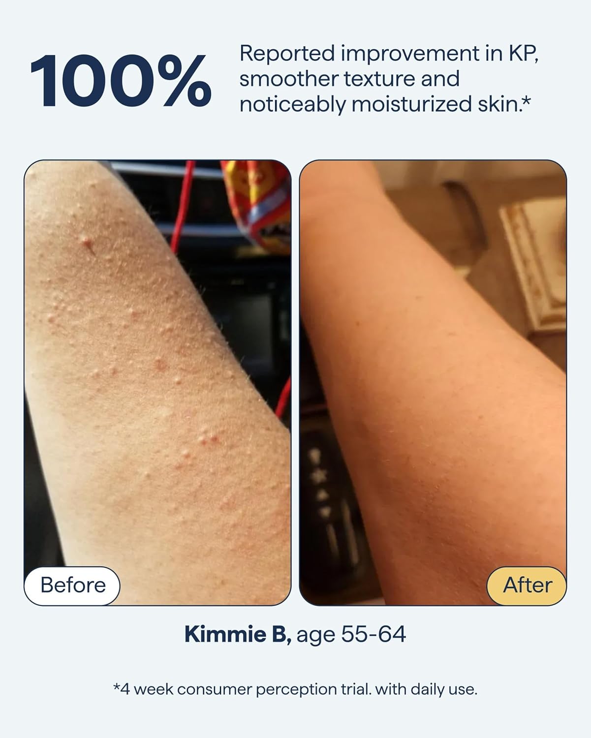 Remedy Science Body Bumps treatment in a bottle, formulated to reduce and soothe skin irritation and bumps.